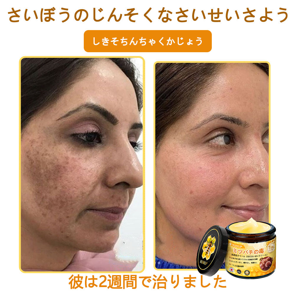 VLSVLS™ 蜂毒配合スキンクリーム（フルケアタイプ）🧑‍⚕️ 皮膚科医も推薦！ 肌トラブル全般に対応した高機能クリームです