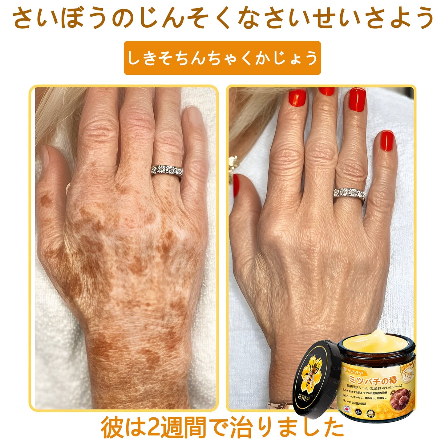 VLSVLS™ 蜂毒配合スキンクリーム（フルケアタイプ）🧑‍⚕️ 皮膚科医も推薦！ 肌トラブル全般に対応した高機能クリームです