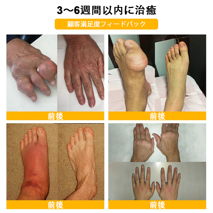 🔥🔥TLOPA®ボツリヌストキシンとビーベノムの骨の痛みを和らげ、癒すバーム🐝（整形外科医がシニアに推奨）🔥。