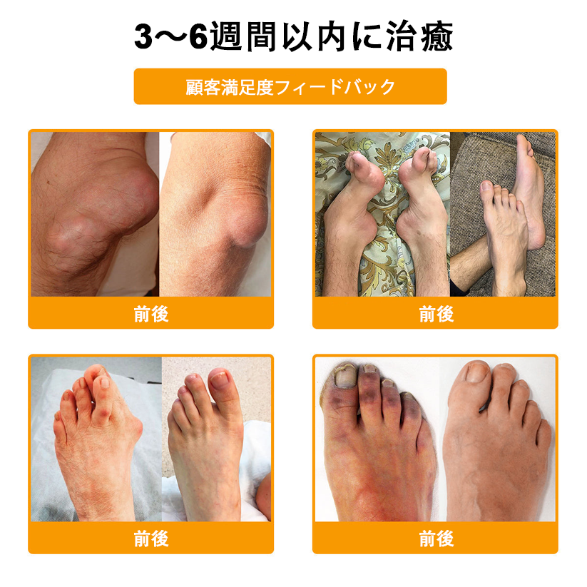 🔥🔥TLOPA®ボツリヌストキシンとビーベノムの骨の痛みを和らげ、癒すバーム🐝（整形外科医がシニアに推奨）🔥。